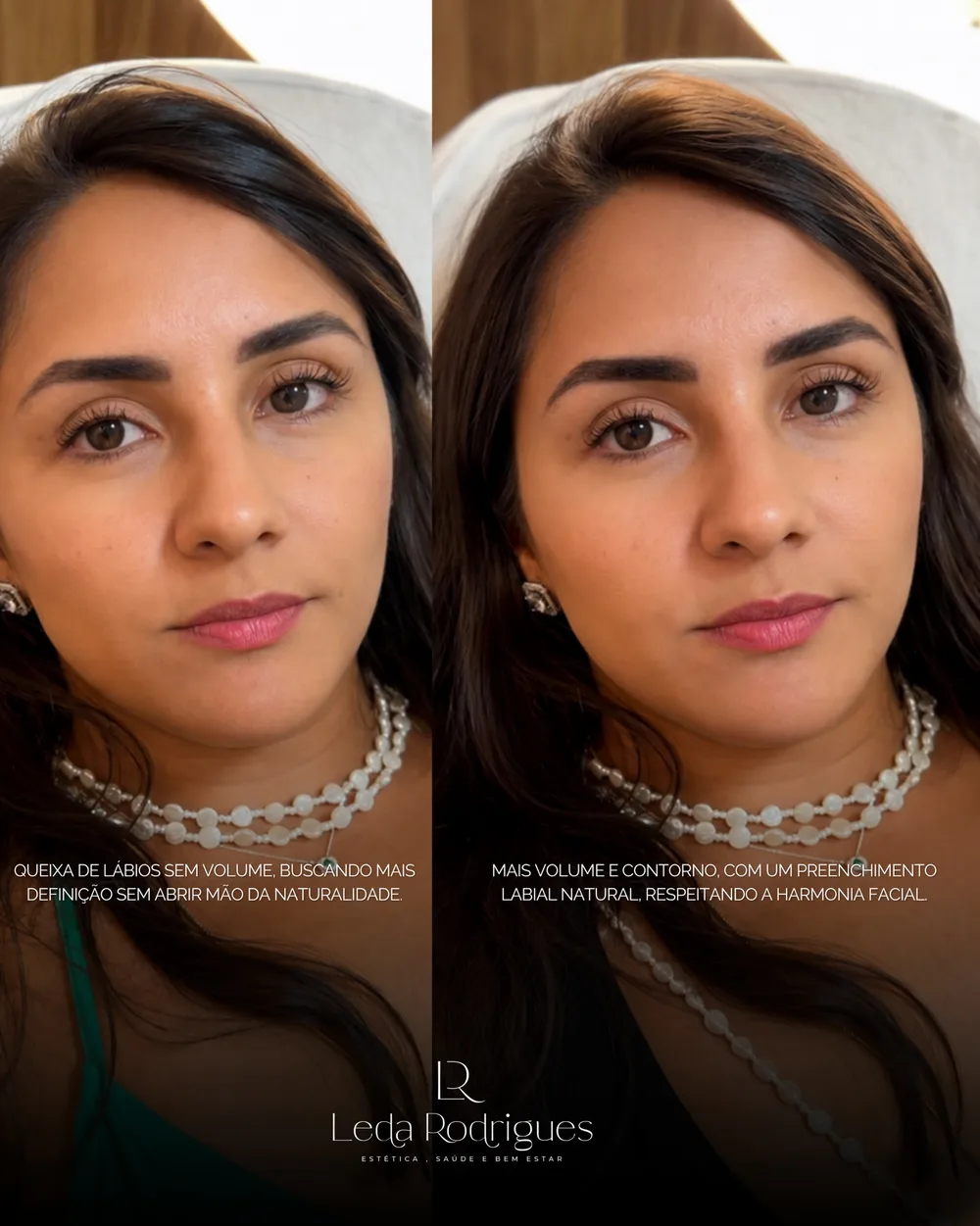 Antes e depois de preenchimento labial com volume e definição preservando o contorno