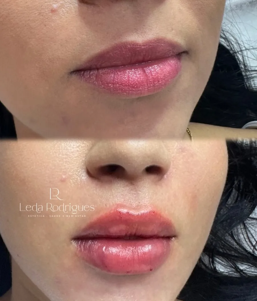 Antes e depois de preenchimento labial: lábios hidratados e volumosos