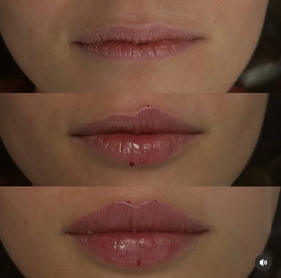 Antes, durante e depois de preenchimento labial