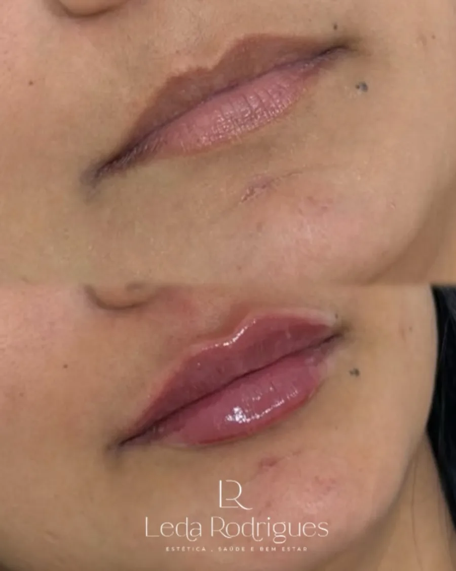 Antes e depois de ajuste labial com 0,05 ml