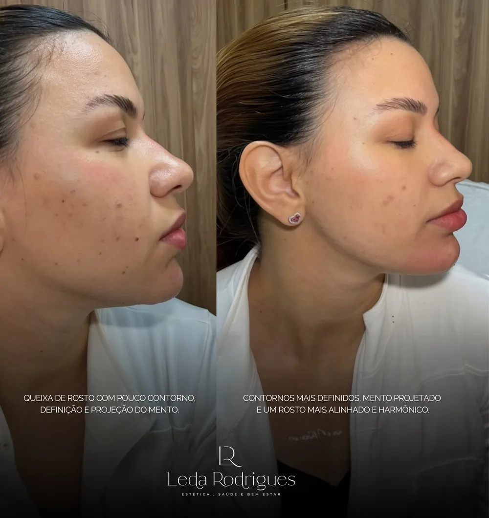 Antes e depois de projeção de mento, perfil mais alinhado