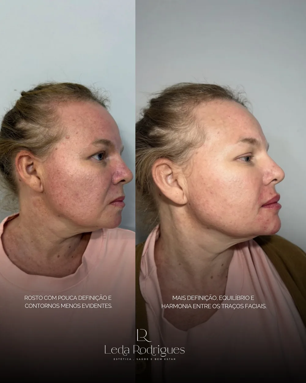 Antes e depois de preenchimento de mento com mais definição e contorno