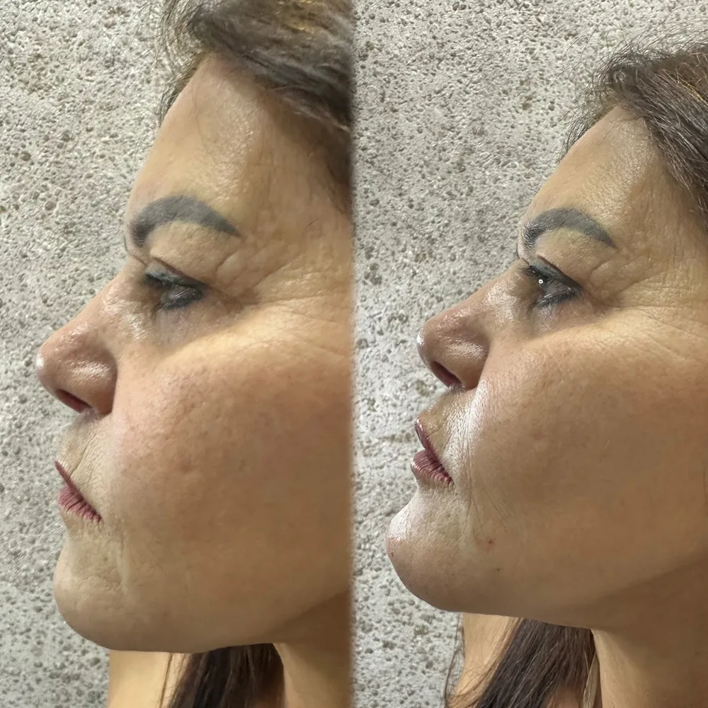 Antes e depois de projeção de mento com 1 ml