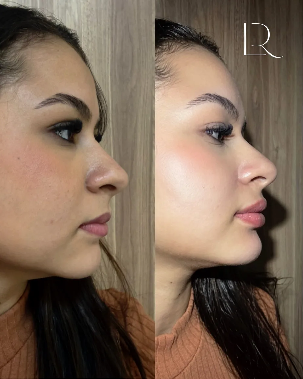 Antes e depois de 2 ml divididos entre lábio e mento