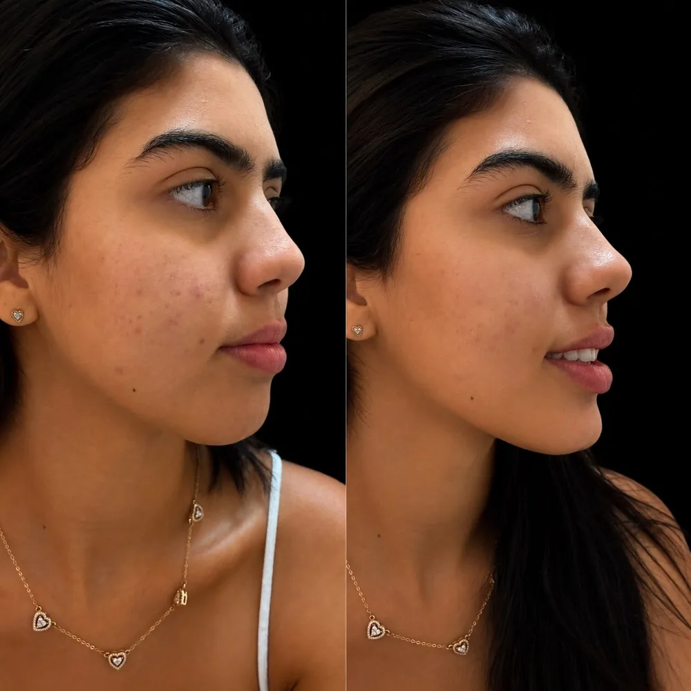 Antes e depois de preenchimento labial e mento